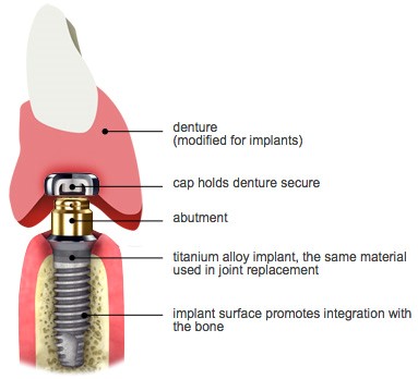 Types Of Dentures Intercourse PA 17534